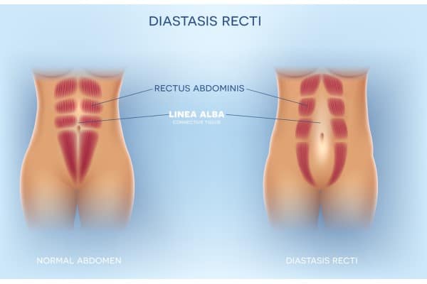 What Non-Surgical Options Are Available for Diastasis Recti Reading?
