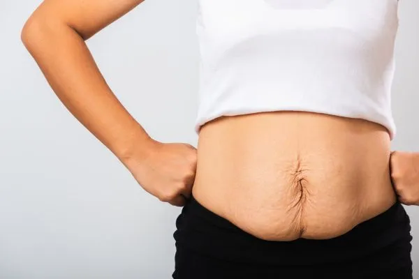 Image of a woman's stomach after weight loss with sagging skin following a gastric band Reading