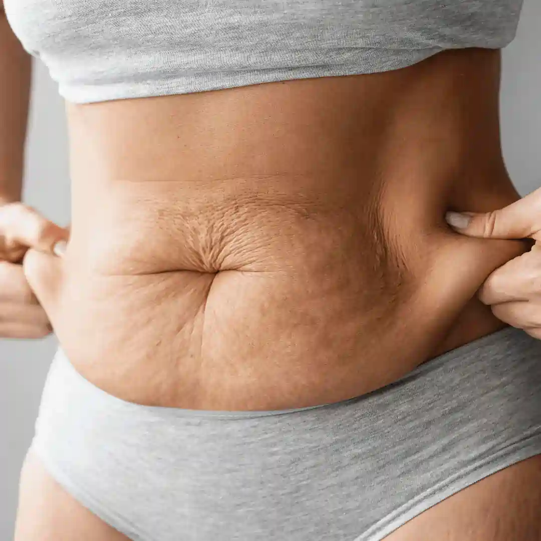 Is It Normal to Have Loose Skin After Pregnancy Reading?