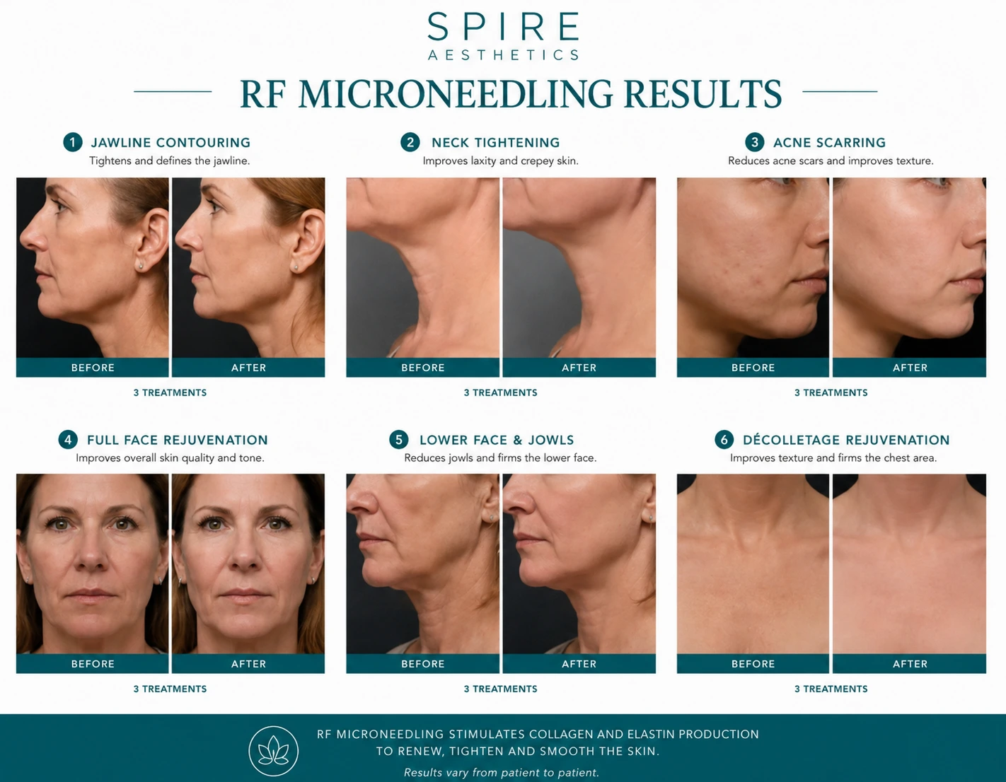 RF Microneedling Skin tightening Reading results