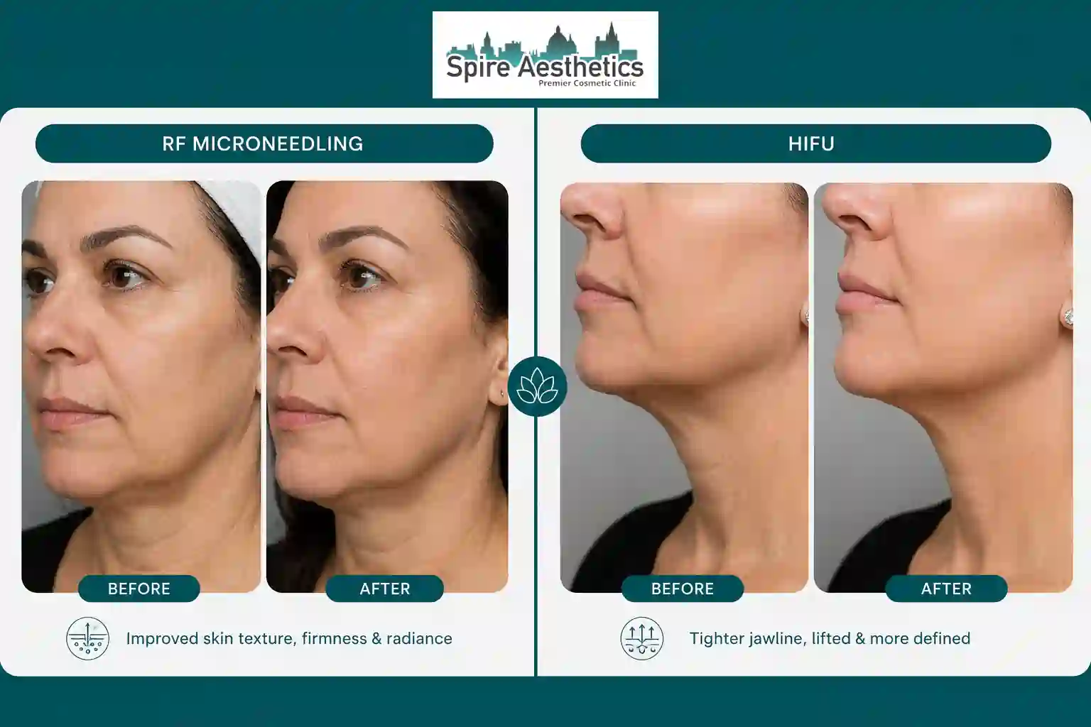 Can RF Microneedling and HIFU Be Combined Reading?