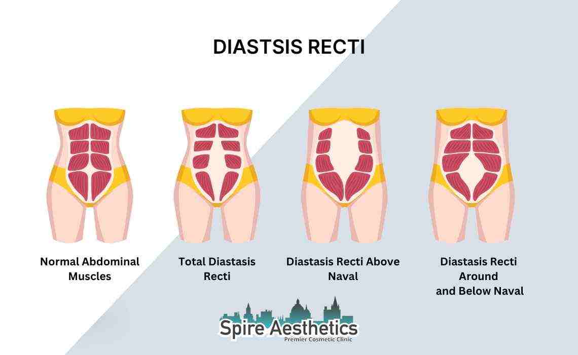 Is Non-Surgical Diastasis Recti Treatment Right for You? Common Concerns Answered Reading